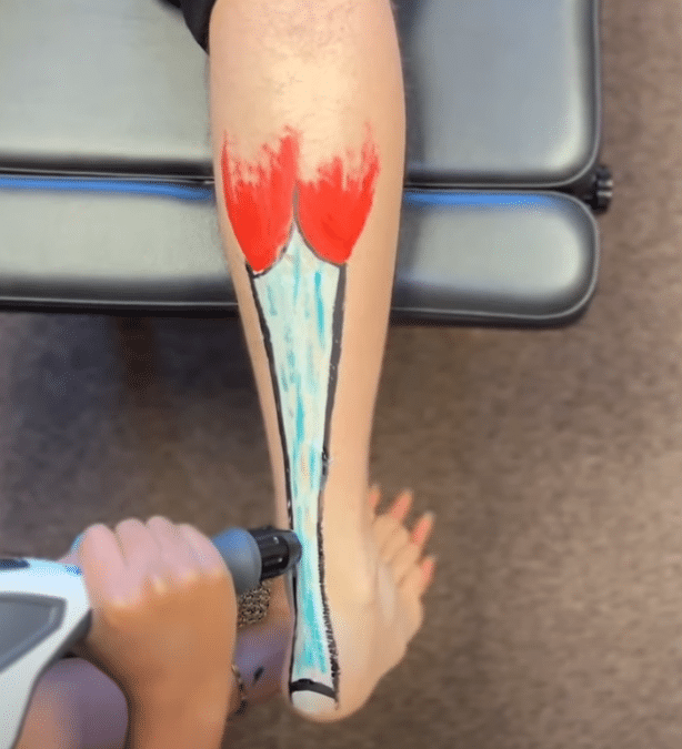 Shockwave Therapy: A Game-Changer for Achilles Pain Relief